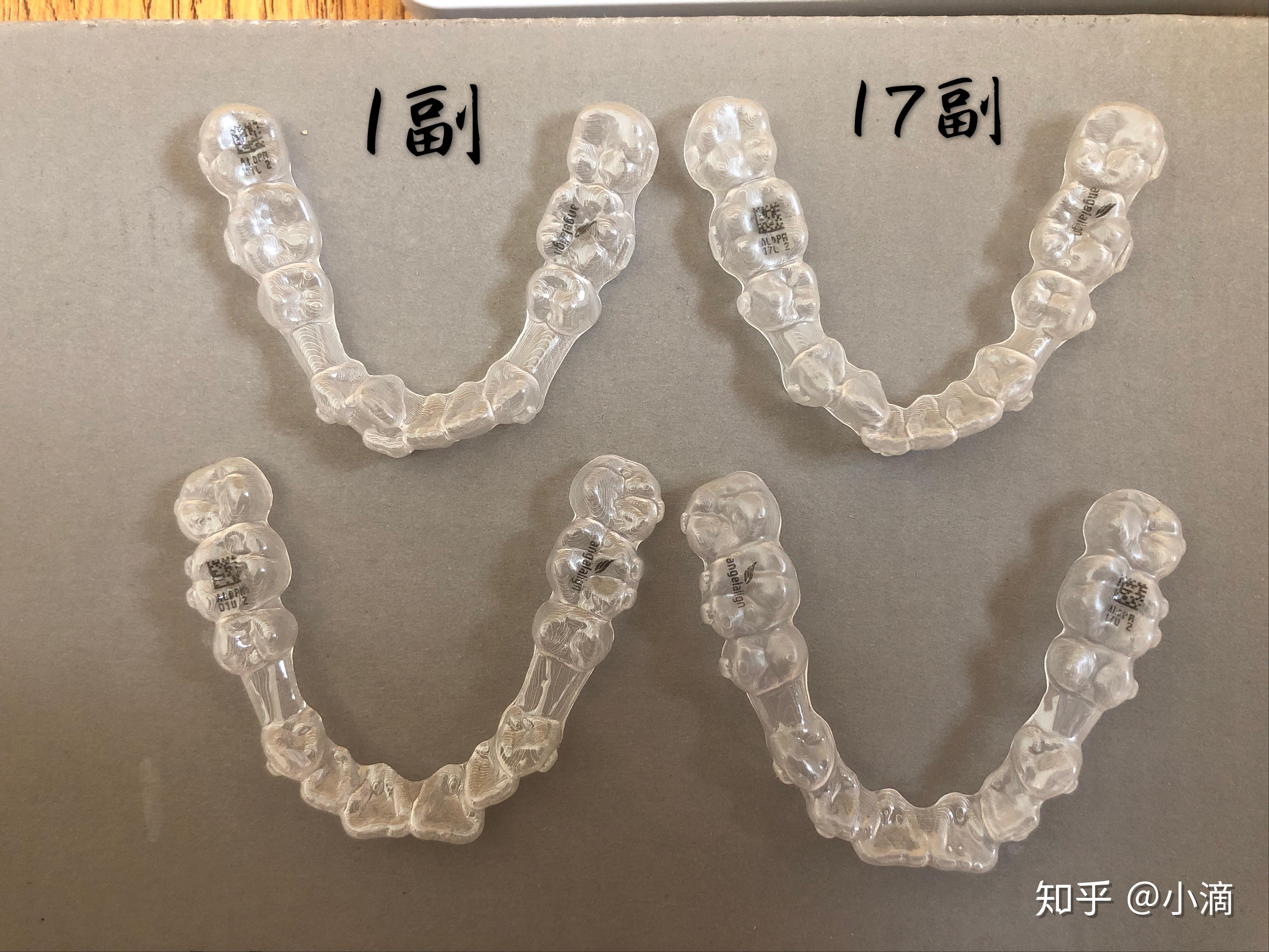 時代天使牙套價格揭秘，小巷中的美麗蛻變之旅啟動！